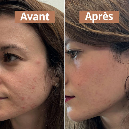 Sérum visage anti-imperfections - Hautement concentré